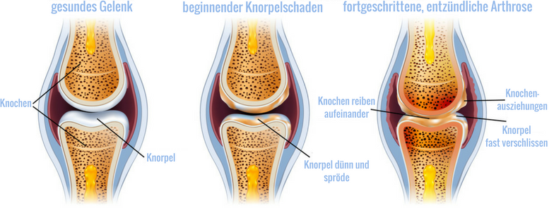 Die Entstehung einer entzündlichen Arthrose im Gelenk Die Entstehung einer entzündlichen Arthrose im Gelenk