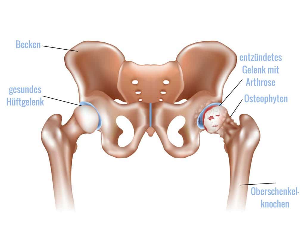 Schmerzen In Den Huftgelenken Therapien Und Alltagstipps Lyprinol De